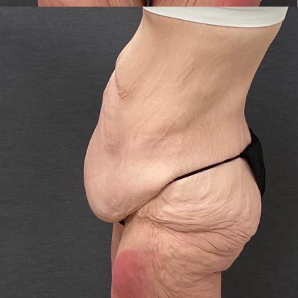 Abdominoplasty Before & After Patient #15933