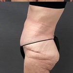 Abdominoplasty Before & After Patient #15933
