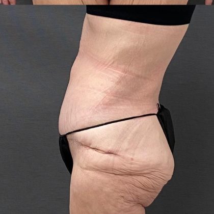Abdominoplasty Before & After Patient #15933