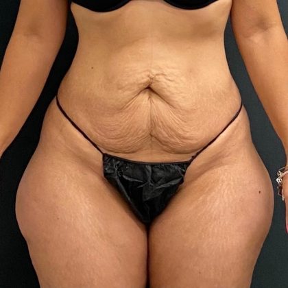 Abdominoplasty Before & After Patient #15934