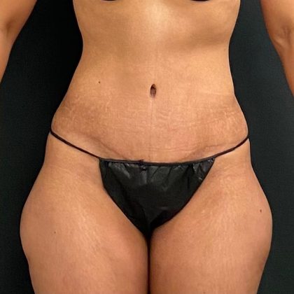 Abdominoplasty Before & After Patient #15934