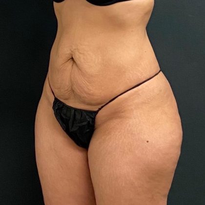 Abdominoplasty Before & After Patient #15934