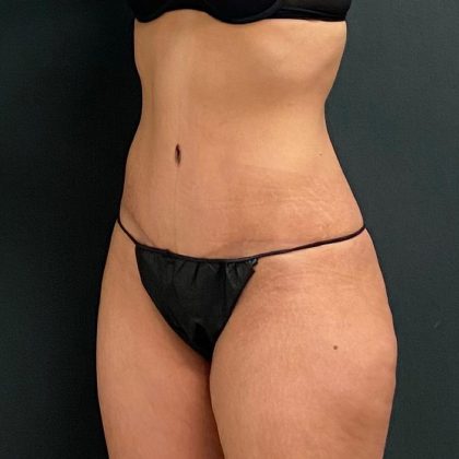 Abdominoplasty Before & After Patient #15934