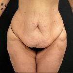 Abdominoplasty Before & After Patient #15935