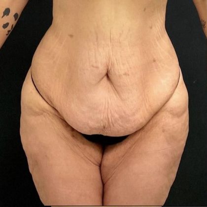 Abdominoplasty Before & After Patient #15935
