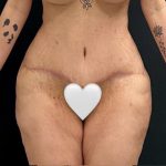 Abdominoplasty Before & After Patient #15935