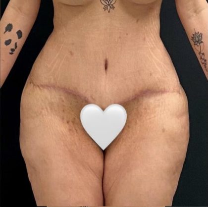 Abdominoplasty Before & After Patient #15935