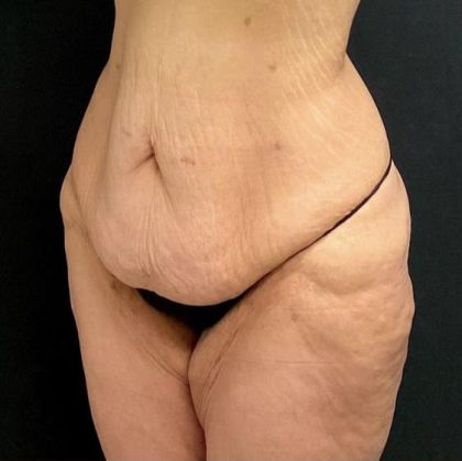 Abdominoplasty Before & After Patient #15935