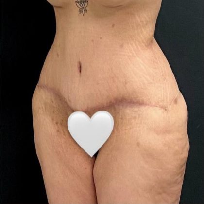 Abdominoplasty Before & After Patient #15935
