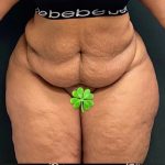 Abdominoplasty Before & After Patient #15936