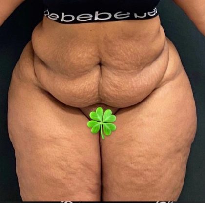 Abdominoplasty Before & After Patient #15936