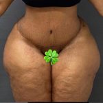 Abdominoplasty Before & After Patient #15936