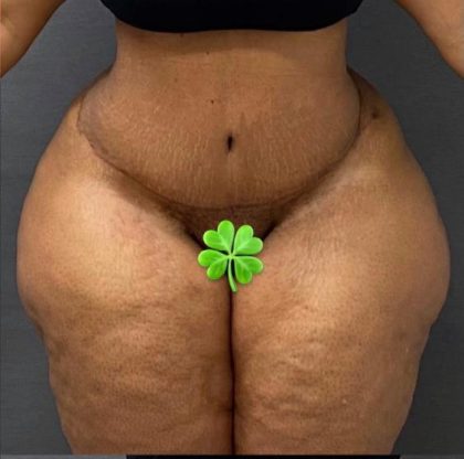 Abdominoplasty Before & After Patient #15936