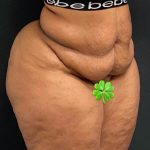 Abdominoplasty Before & After Patient #15936