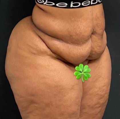 Abdominoplasty Before & After Patient #15936