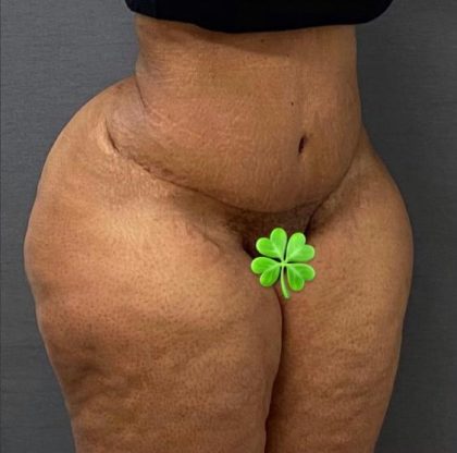 Abdominoplasty Before & After Patient #15936