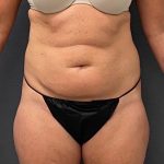Abdominoplasty Before & After Patient #15937