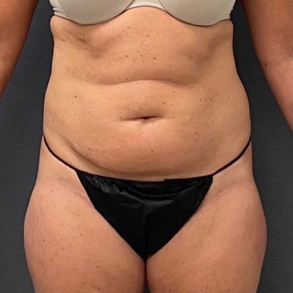 Abdominoplasty Before & After Patient #15937