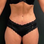 Abdominoplasty Before & After Patient #15937