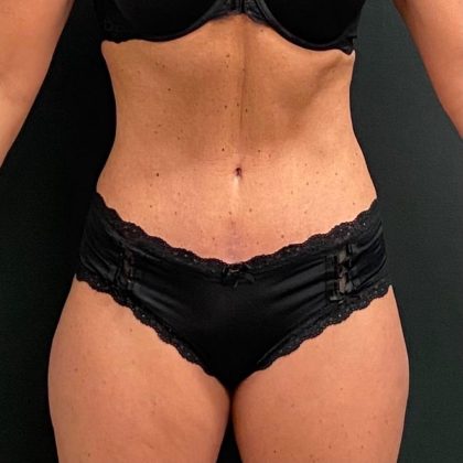 Abdominoplasty Before & After Patient #15937