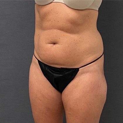 Abdominoplasty Before & After Patient #15937
