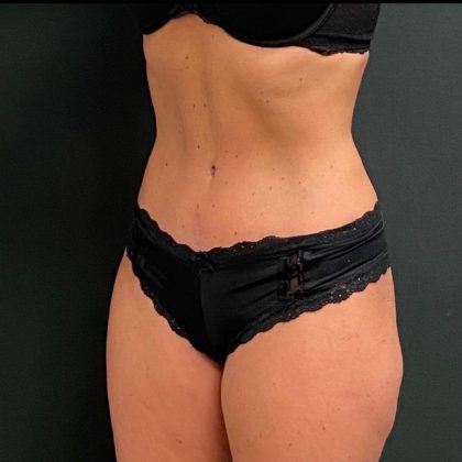 Abdominoplasty Before & After Patient #15937