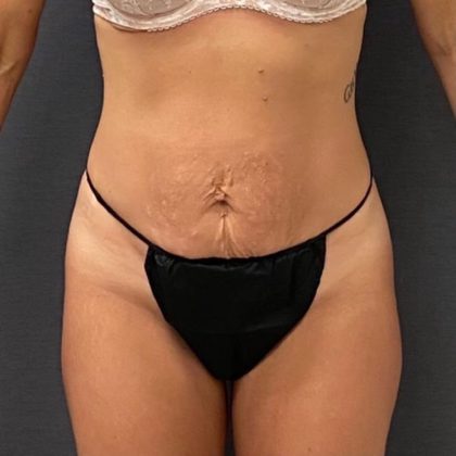 Abdominoplasty Before & After Patient #15938