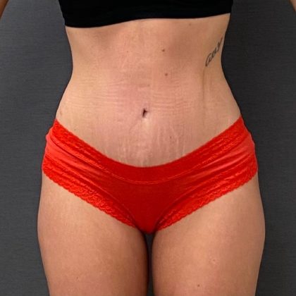 Abdominoplasty Before & After Patient #15938
