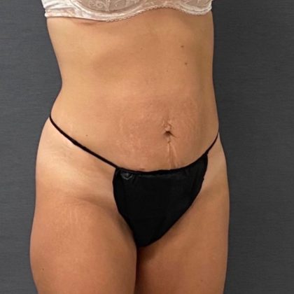 Abdominoplasty Before & After Patient #15938