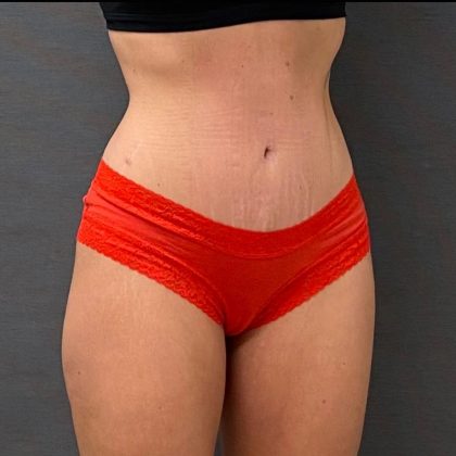 Abdominoplasty Before & After Patient #15938
