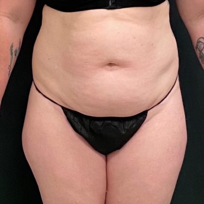 Abdominoplasty Before & After Patient #15939