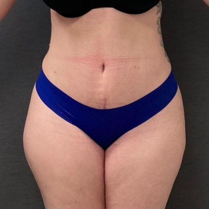 Abdominoplasty Before & After Patient #15939