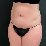 Abdominoplasty Before & After Patient #15939