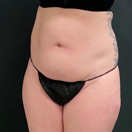 Abdominoplasty Before & After Patient #15939