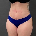 Abdominoplasty Before & After Patient #15939
