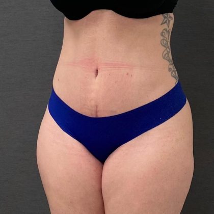 Abdominoplasty Before & After Patient #15939