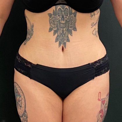 Abdominoplasty Before & After Patient #15940