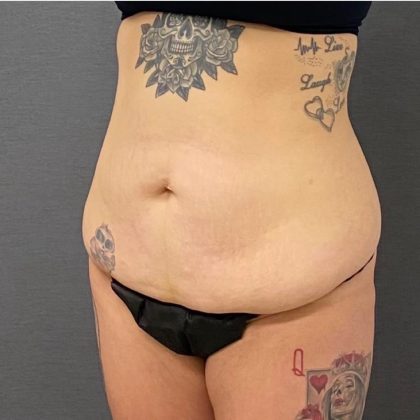 Abdominoplasty Before & After Patient #15940