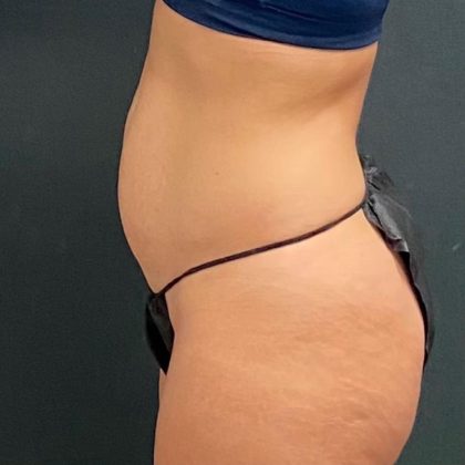 Abdominoplasty Before & After Patient #15941