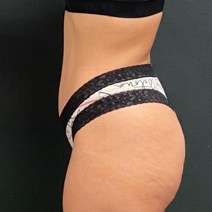 Abdominoplasty Before & After Patient #15941