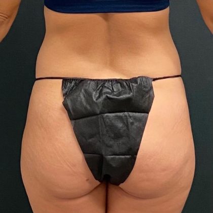 Abdominoplasty Before & After Patient #15941