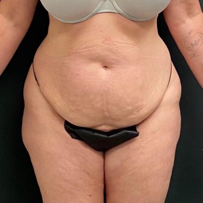 Abdominoplasty Before & After Patient #15942
