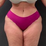 Abdominoplasty Before & After Patient #15942