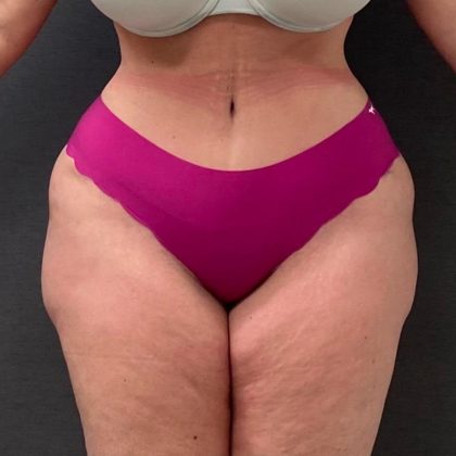 Abdominoplasty Before & After Patient #15942