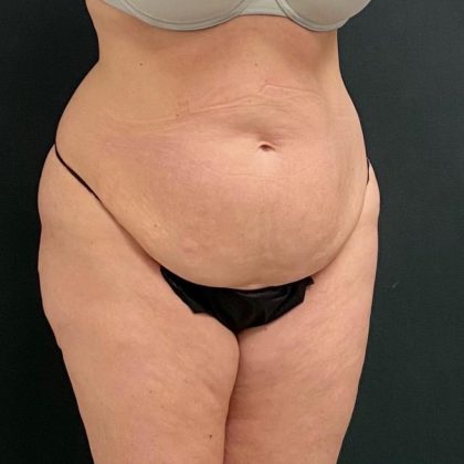 Abdominoplasty Before & After Patient #15942