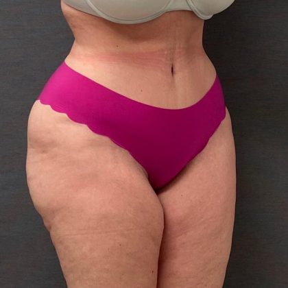 Abdominoplasty Before & After Patient #15942