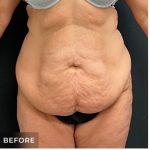 Abdominoplasty Before & After Patient #15907
