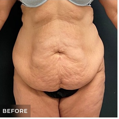 Abdominoplasty Before & After Patient #15907