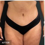 Abdominoplasty Before & After Patient #15907