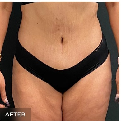 Abdominoplasty Before & After Patient #15907